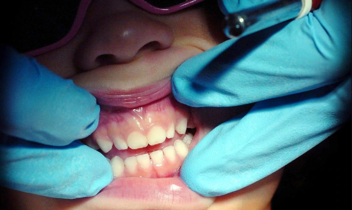 Dentistas recomendam que os pais escovem os dentes dos filhos até os 9 anos